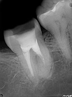 抜歯しない治療 症例14 根管探索中にパーフォレーションを起こした症例