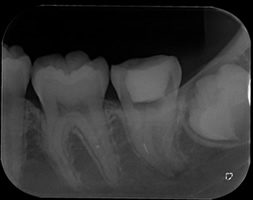 抜歯しない治療 症例16 破折ファイルとパーフォレーションの症例