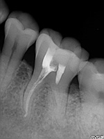 抜歯しない治療 症例21 遠心根管が全く見えない石灰化している症例