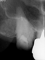 奥歯で器具操作が難しい症例：術前