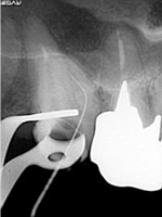 奥歯で器具操作が難しい症例：術中