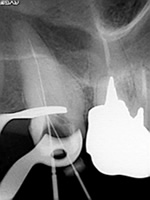 奥歯で器具操作が難しい症例：術中2