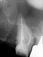 奥歯で器具操作が難しい症例：術後