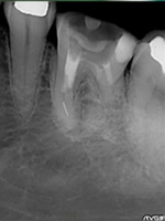抜歯しない治療 症例 25.　治療用器具の破折と穿孔症例