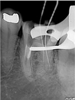 治療用器具の破折と穿孔症例：術中2