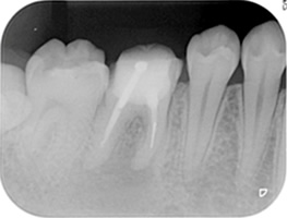 抜歯しない治療 症例 26.　治療用器具破折の症例