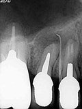 抜歯しない治療 症例10 ハイパー根管治療から外科的歯内療法に移行したケース