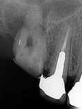 ひどい虫歯の治療 1