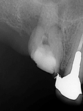ひどい虫歯の治療 2