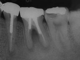 抜歯しない治療 症例4　根管内に穿孔が２カ所あったケース
