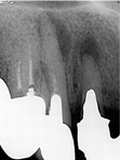 抜歯しない治療 症例7 インプラントとハイパー根管治療の共存